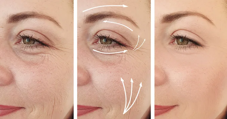 Professionelle Faltenunterspritzung in Biedermannsdorf bei Mödling